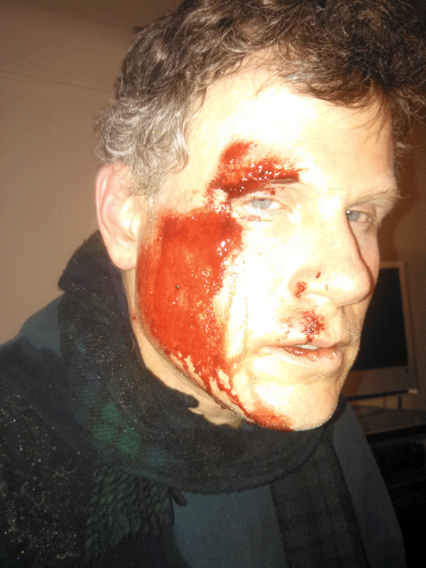 Attorneys to talk at Westbeth on avoiding cycling accidents 1 Steve Vaccaro after a nasty crash on the Riverside Park bike path in February. He has sued the city over a dangerous condition that caused the accident.