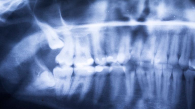 Stock image of an x-ray of teeth. 