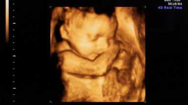 Sonogram istock cropped