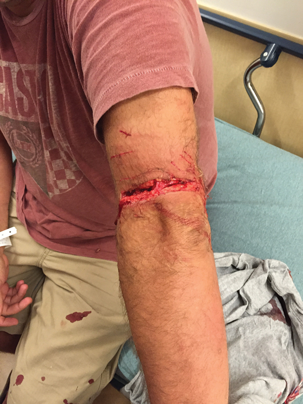 Ed Vassilev showing his major arm wound at Beth Israel Hospital after being attacked by a pit bull on Second Ave. The dog’s bite severed the first layer of nerves on his forearm, but luckily not the deeper nerves that control finger and arm movement.