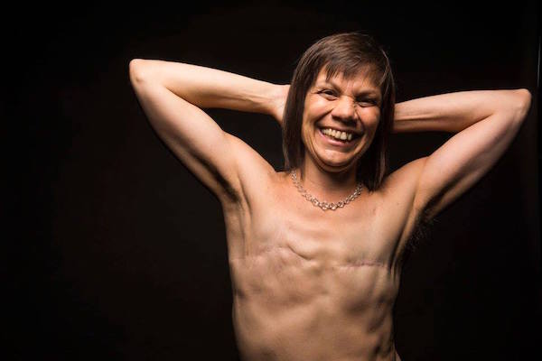 Melanie Testa had a bilateral mastectomy, saying that it was important to have symmetry in her breasts. Photo by Damon Dahlen.
