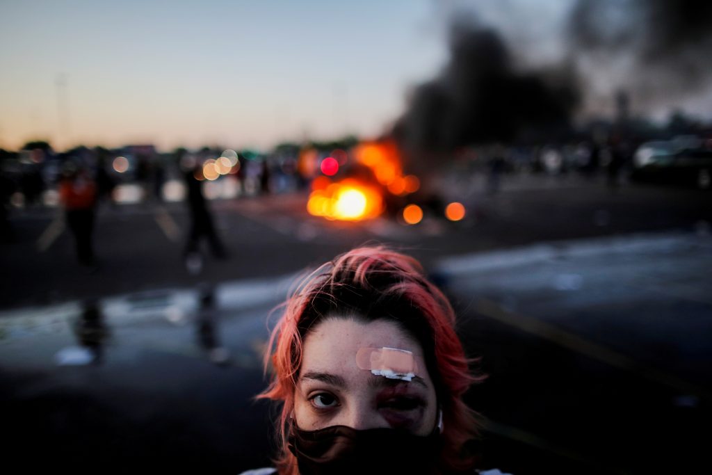 Perez is pictured with bruising around her eye and a plaster on her forehead, injuries sustained from rubber bullets during protests yesterday, in Minneapolis