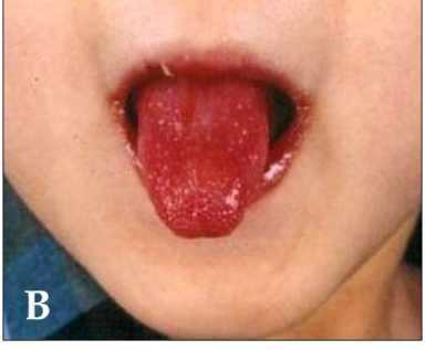 Kawasaki_symptoms_B