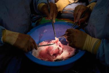 Pig-Human Transplants