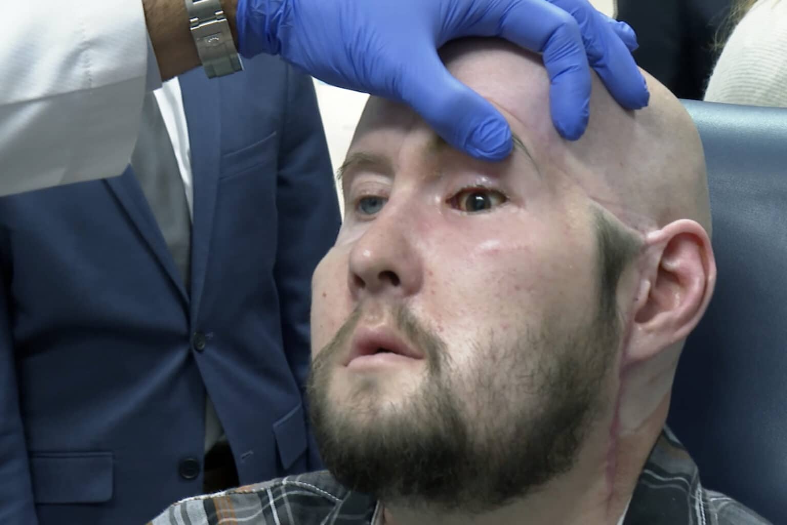 Man receives the first eye transplant plus a new face. It’s a step