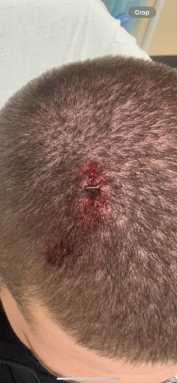 An NYPD officer was left requiring two staples to his head after he was attacked during a protest on Saturday night, authorities said.