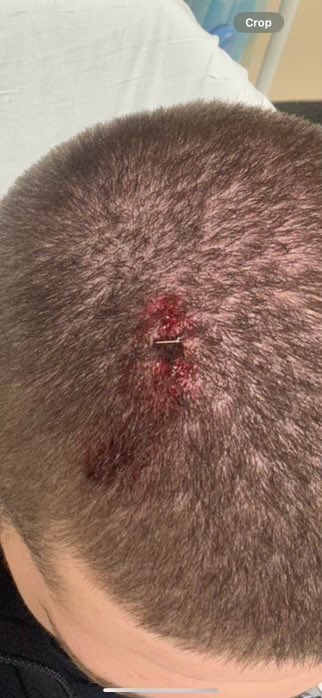 An NYPD officer was left requiring two staples to his head after he was attacked during a protest on Saturday night, authorities said.