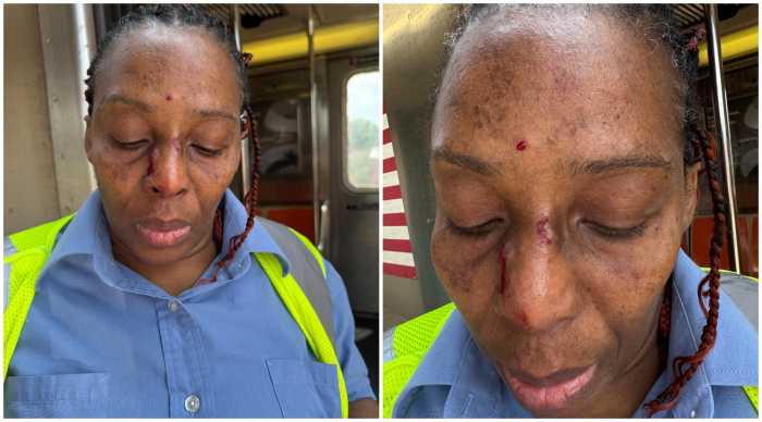 Marshalee Reid shows injuries sustained during an assault at the New Lots Avenue subway station in Brooklyn